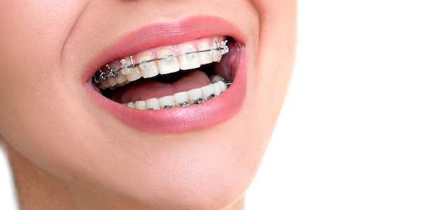 How to Find the #1 Orthodontist in Woodbury NY and Why it Matters