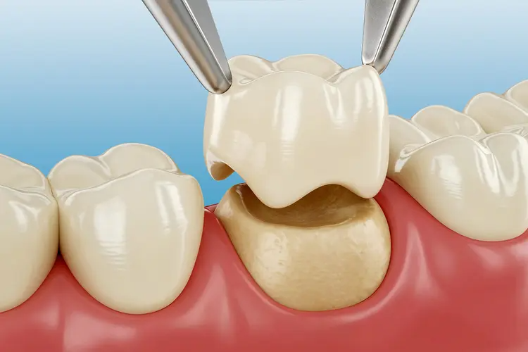 dental crown in Agoura Hills