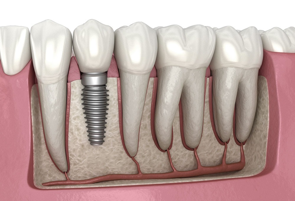 Implants in Agoura Hills