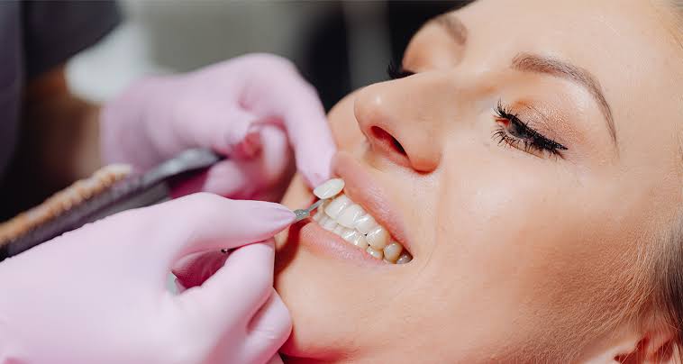 Porcelain veneers Century City
