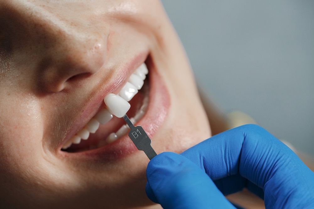 Veneers Century City